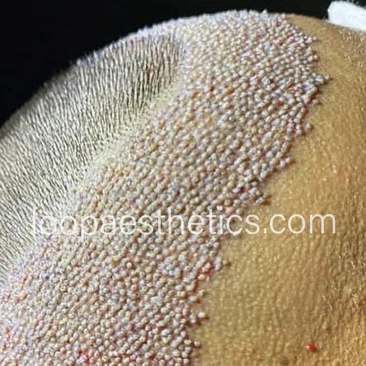 Loop Aesthetics & Hairtransplant
