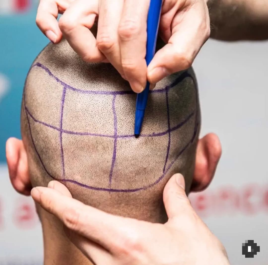 Adonis Med | Hair Transplant — Dermatology & Skin Care in Istanbul