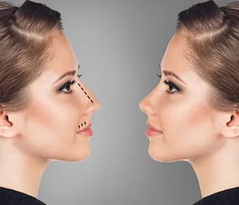 Istanbul Plastic Surgery Support - ( Vaser Liposuction, Nose Job, Tummy Tuck, BBL, Facelift, Implants, Laser, Lip Lift, Gynecomastia)