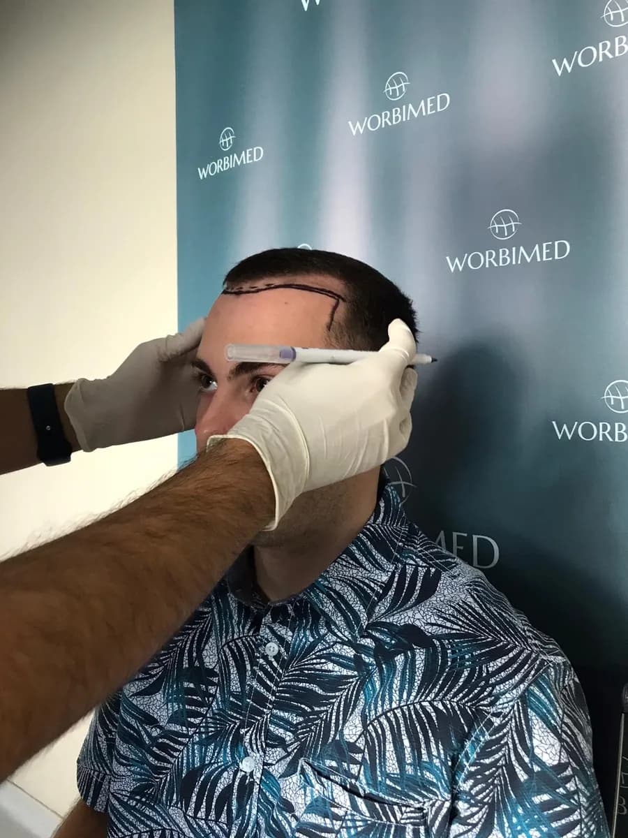Worbimed | Hair Transplant Turkey Istanbul | Eyebrow Transplant | Beard Transplant