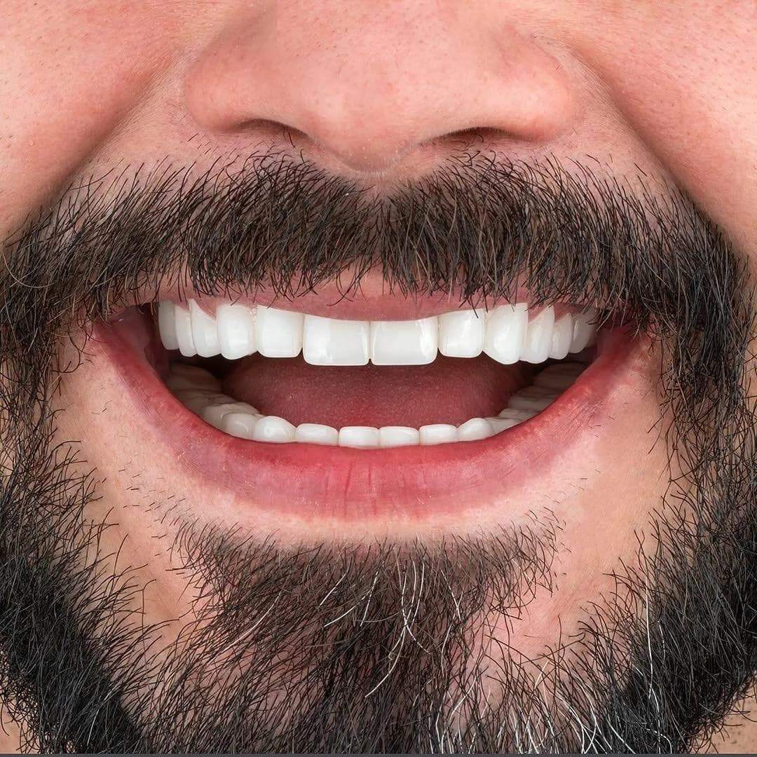 Türkiye Dental | Dental Implant | Hollywood Smile — Dental Clinics in Istanbul