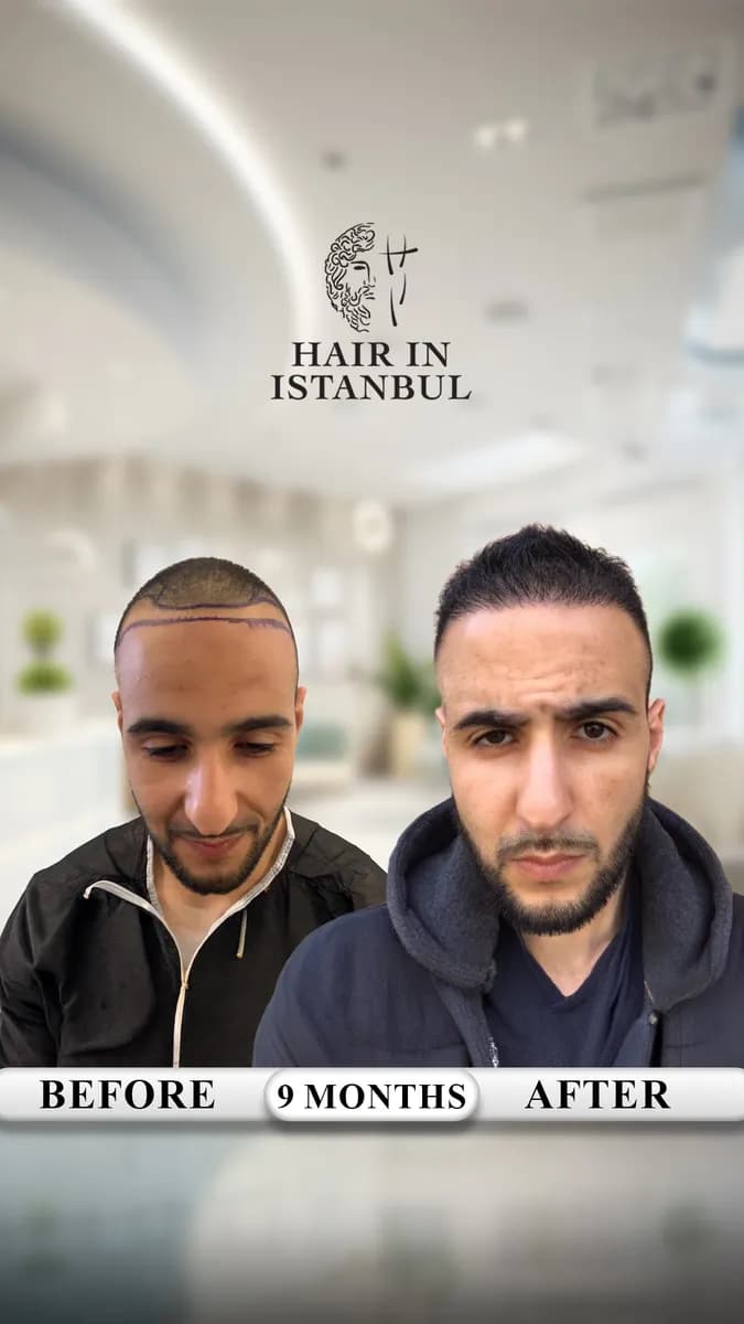 Hair in istanbul | Hair Transplant in Turkey