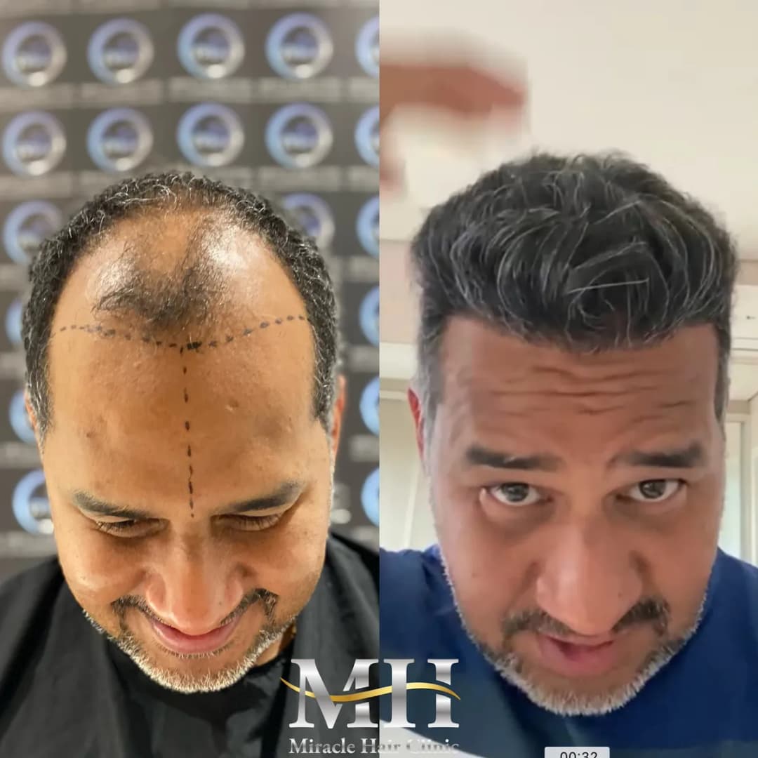 Miracle Hair Clinic Hair Transplant Turkey