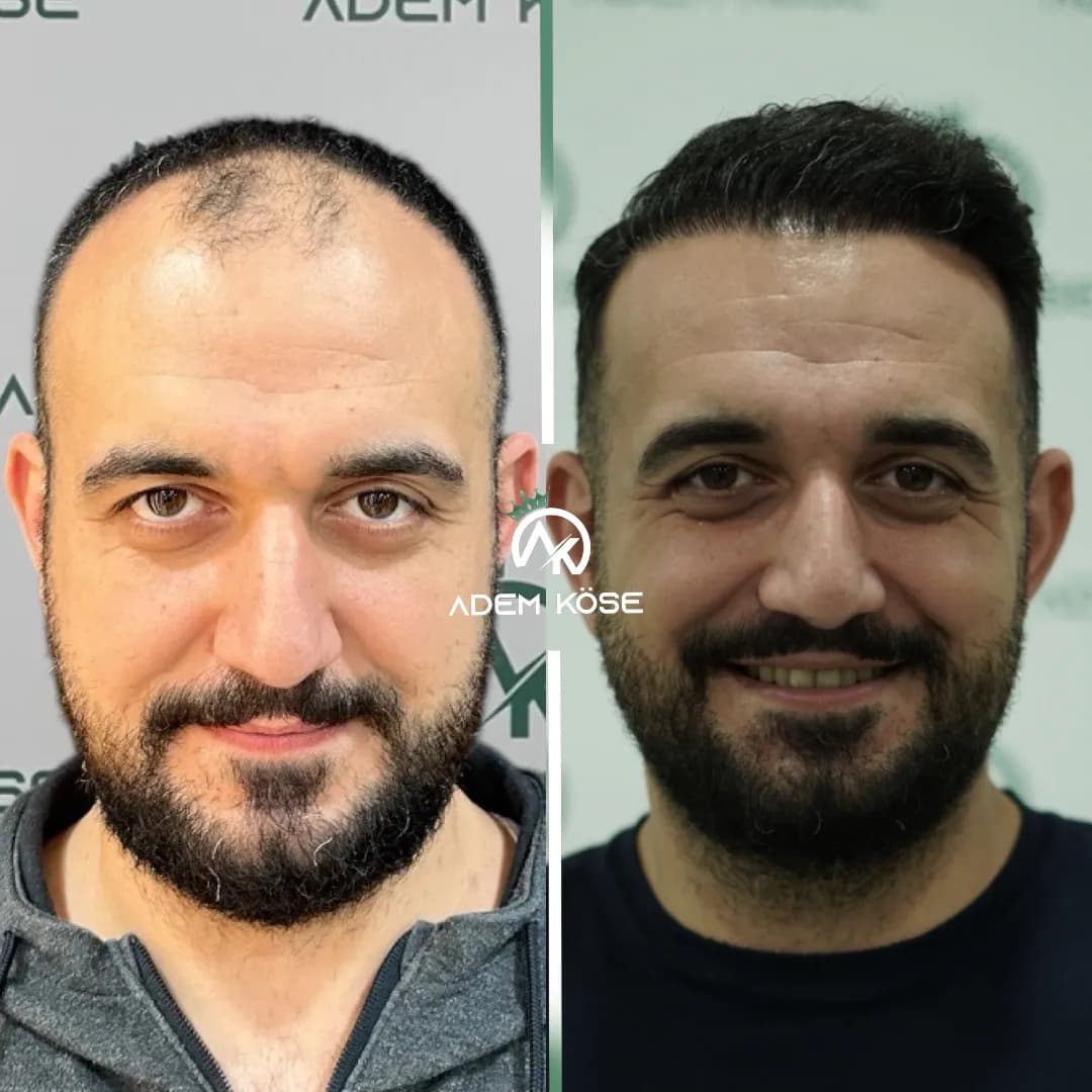 Adem Köse - Hair Transplant Turkey — Dermatology & Skin Care in Istanbul
