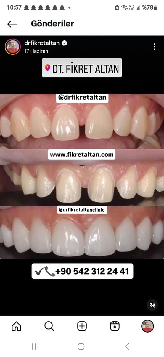ALTAN KLİNİK | DİŞ HEKİMİ FİKRET ALTAN | İmplant, Zirkonyum, Gülüş Tasarımı, Diş Beyazlatma, Estetik Diş | Maslak İSTANBUL — Dental Clinics in Istanbul