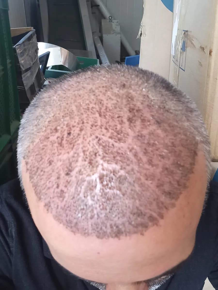Live Hair Clinic - Kartal Saç Ekimi — Dermatology & Skin Care in Istanbul