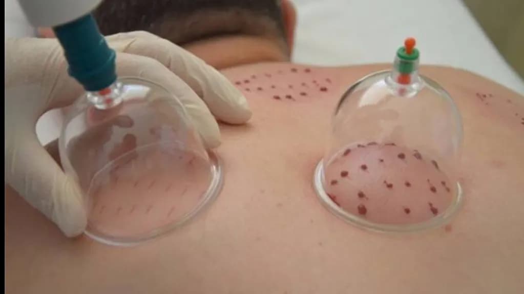 Bağcılar Hacamat ve Sülük Terapi Merkezi — Alternative & Holistic Medicine in Istanbul