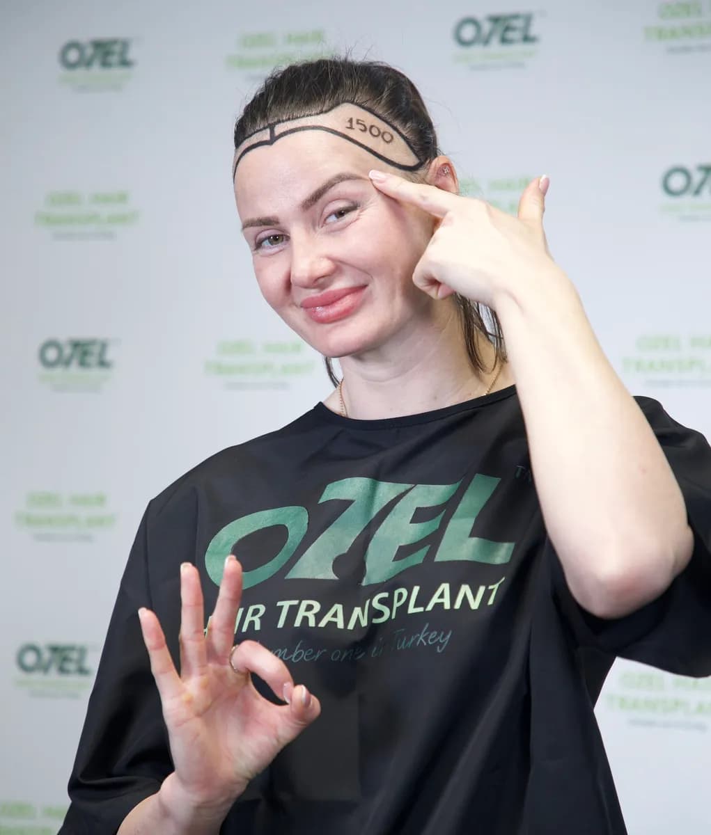 Ozel Hair Transplant — Dermatology & Skin Care in Istanbul