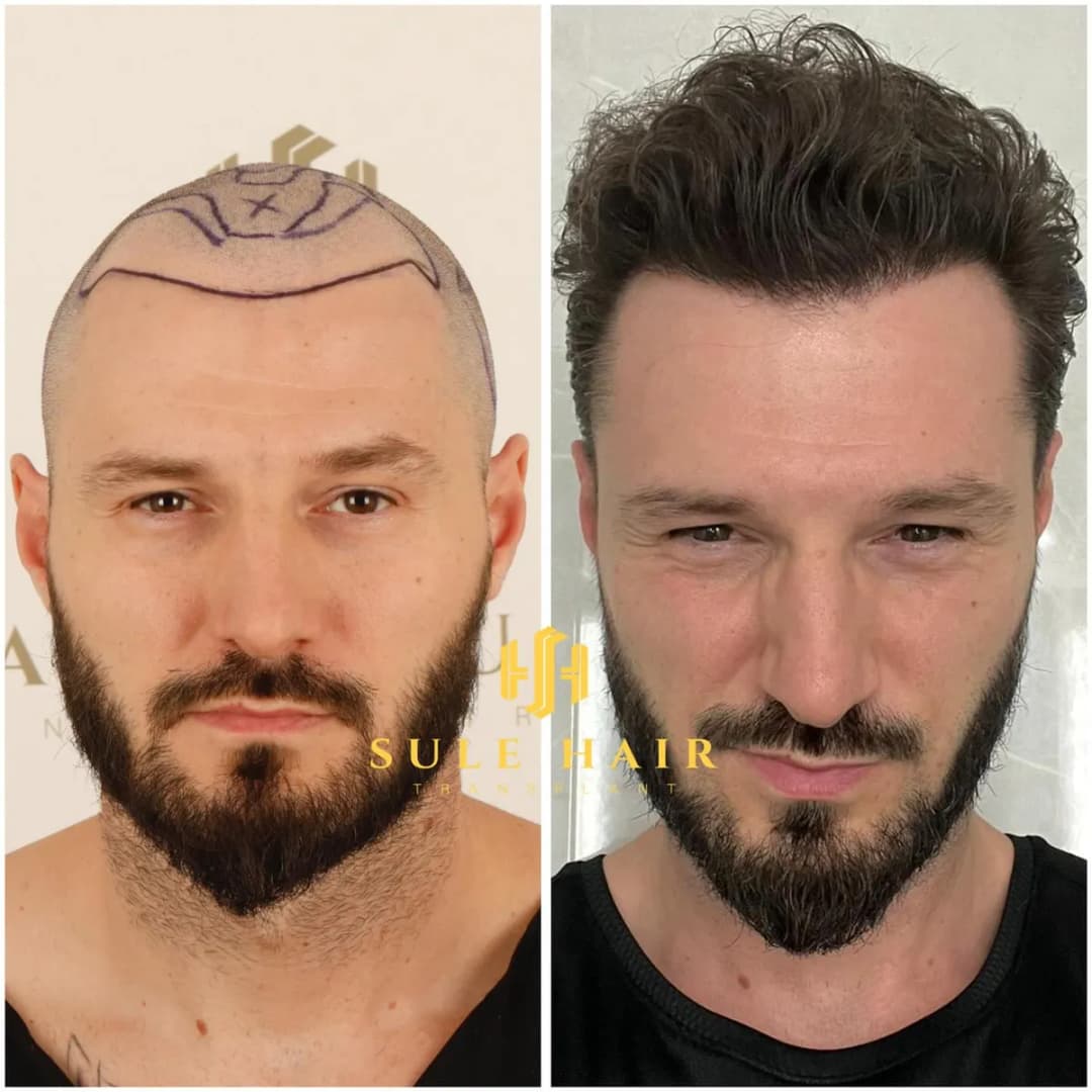 Sule Hair Transplant: Hair Transplant Turkey — Dental Clinics in Istanbul