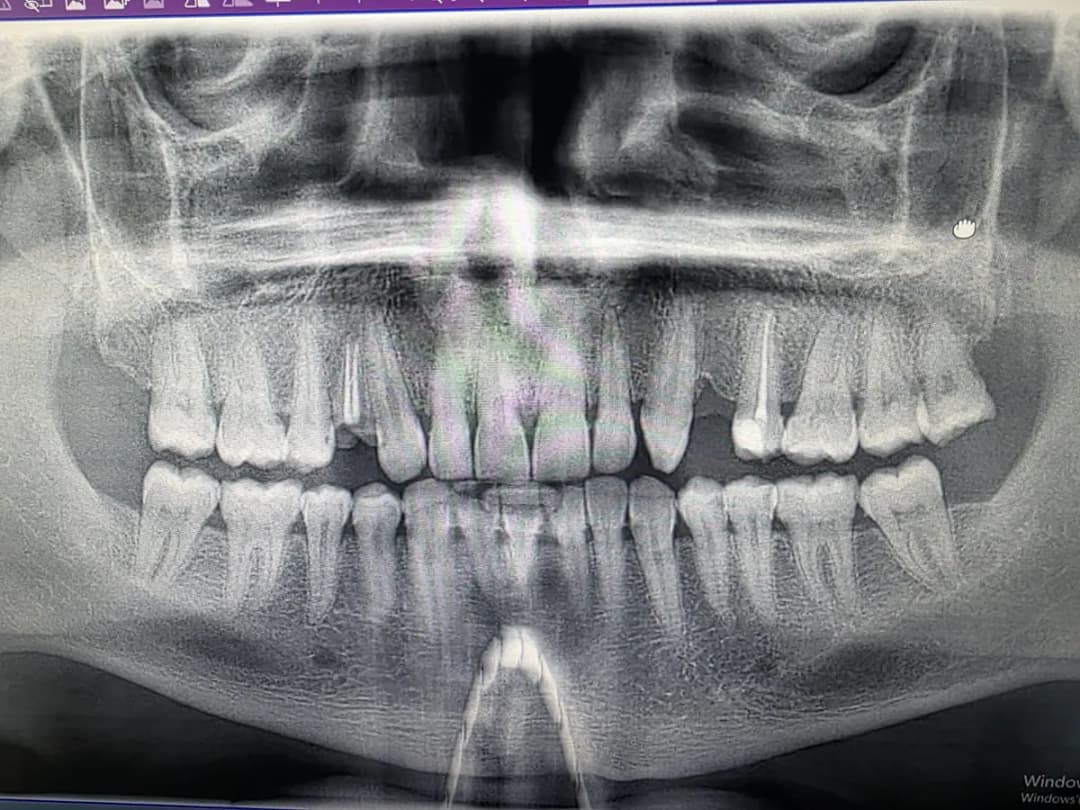 The best dental clinic in turkey | dental implants in turkey | Veneers | All on 4 | Zirconium crowns | ALL ON X clinic