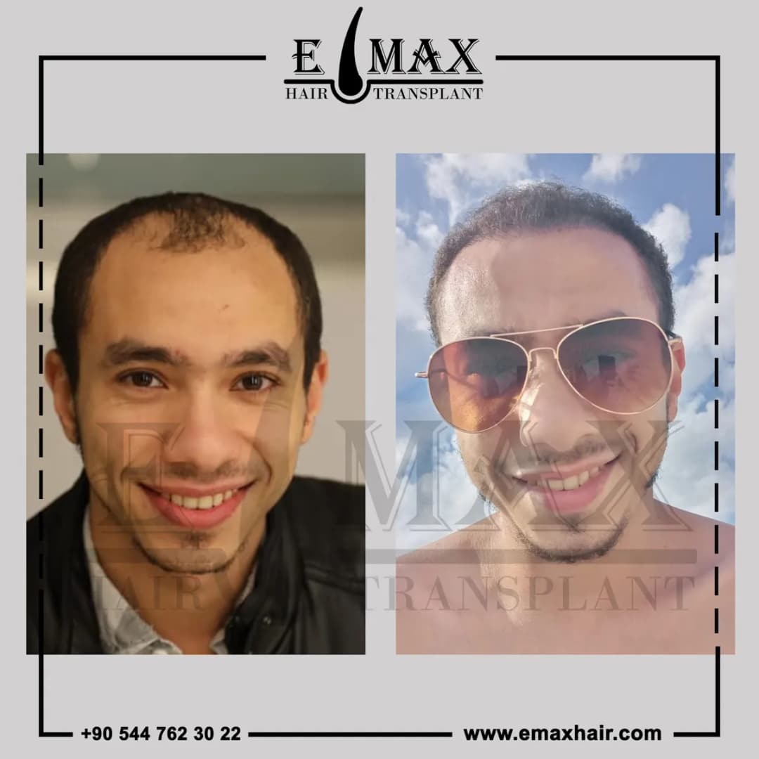 Emax hair