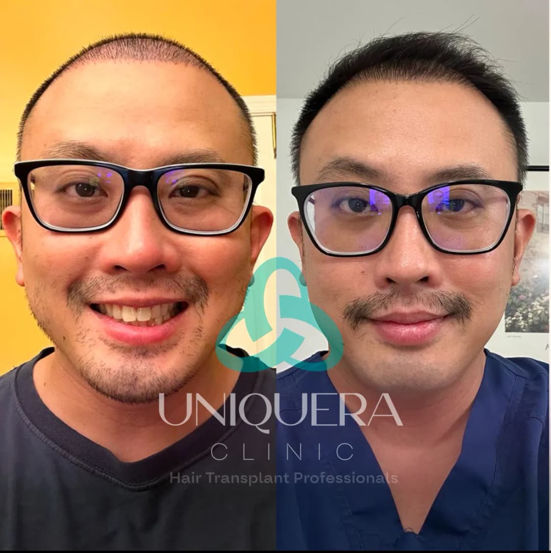 UniquEra Hair Transplant Clinic