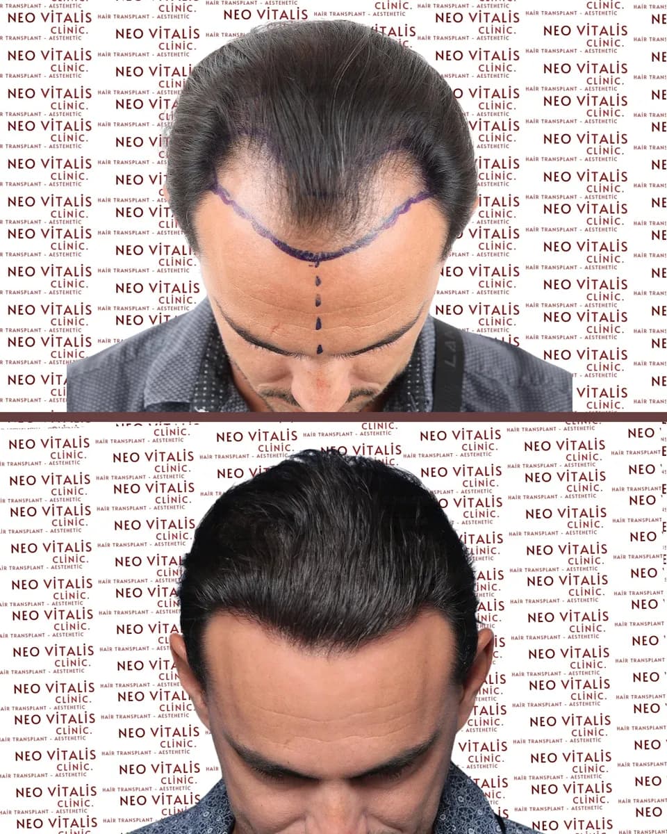 Neo Vitalis Clinic – Hair Transplant — Dermatology & Skin Care in Istanbul