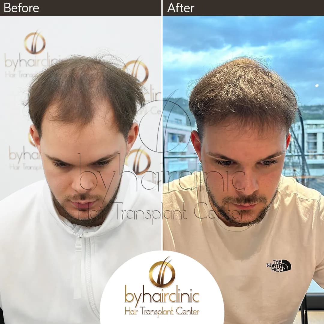 byhairclinic | Hair Transplant Center — Dermatology & Skin Care in Istanbul