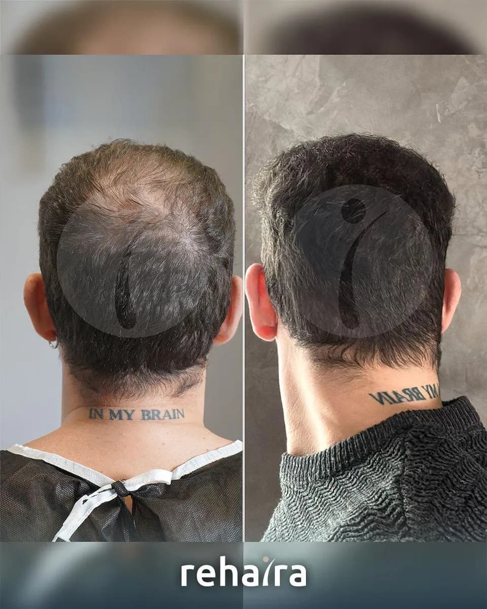 Rehaira DHI Hair Transplant Clinic in Turkey