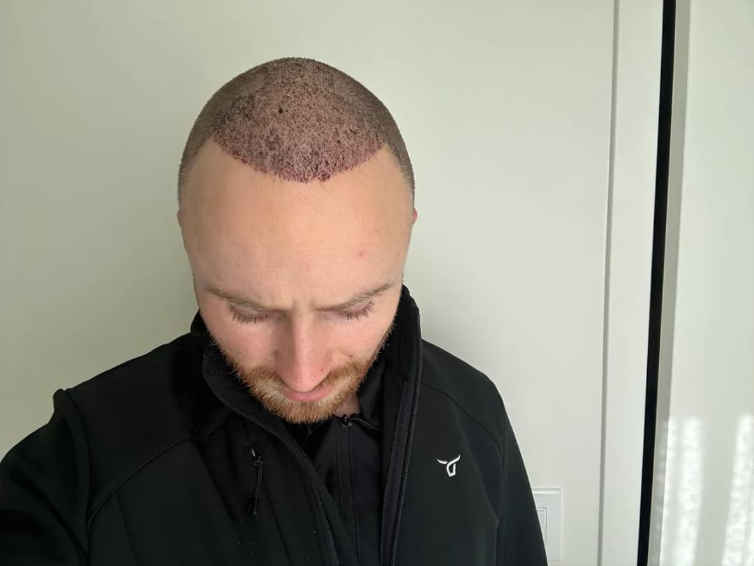 Smile Hair Clinic Hair Transplant Turkey Istanbul