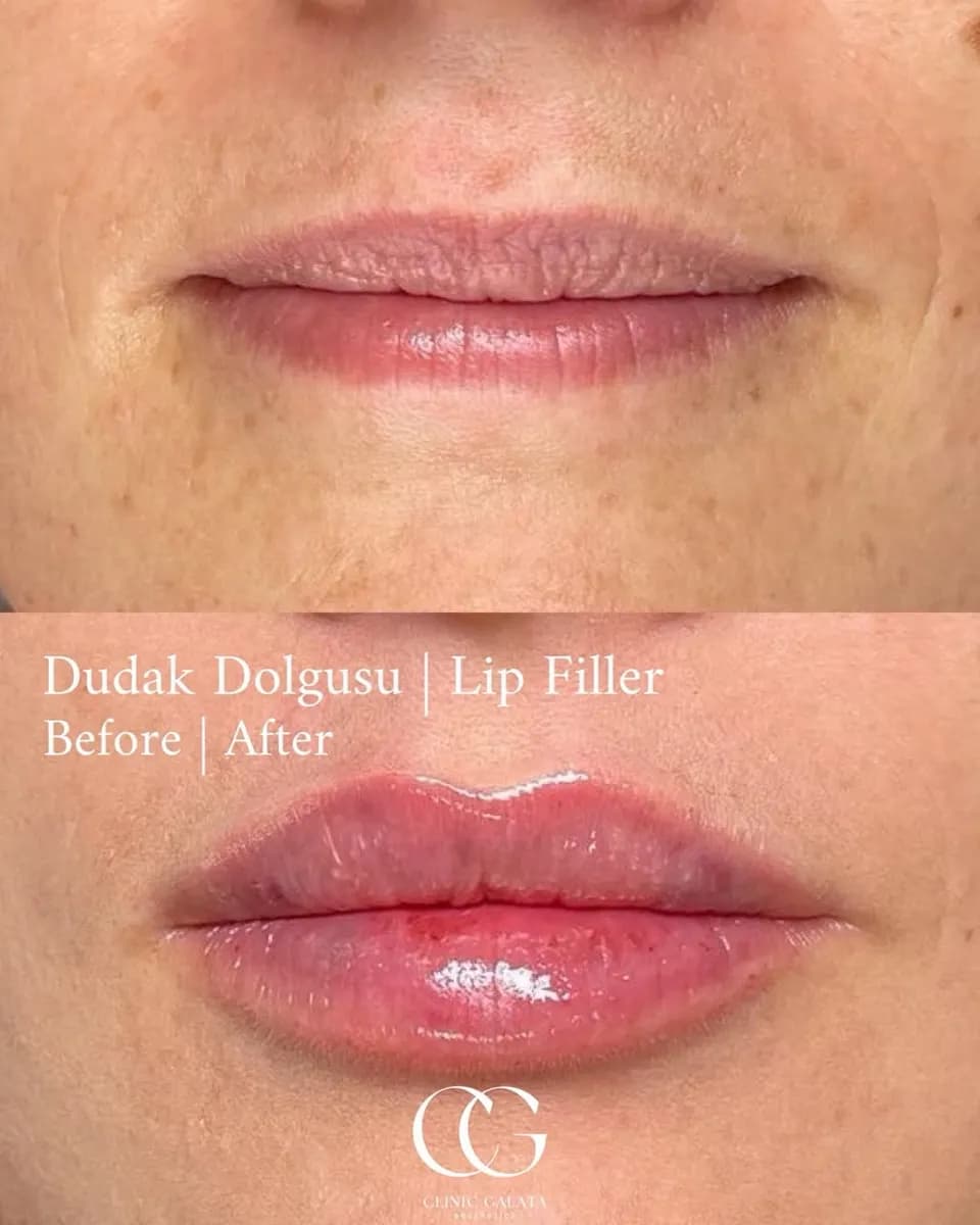 Clinic Galata | Sculptra, Liquid Facelift & Medical Aesthetic Clinic Istanbul