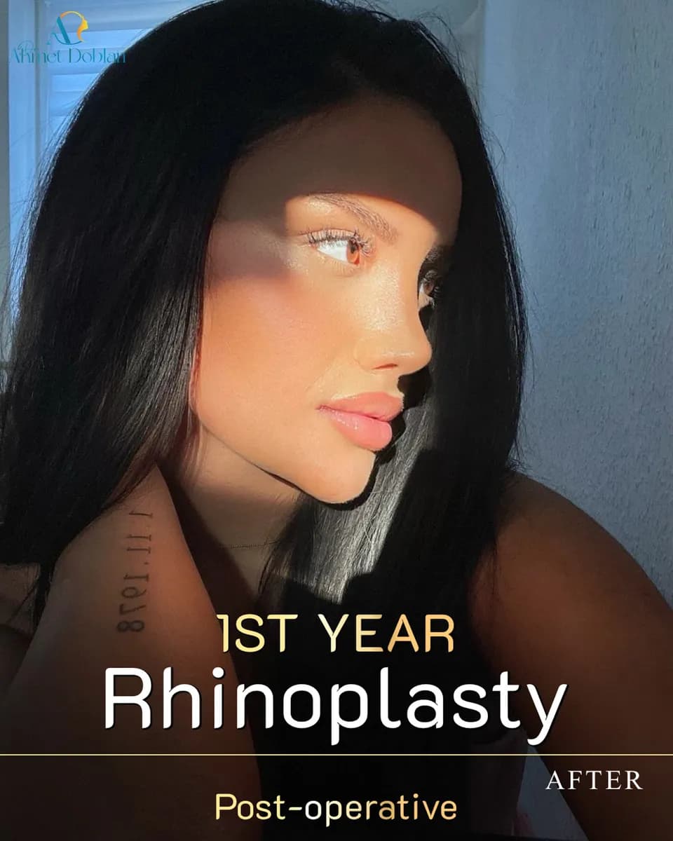 Dr. Ahmet Doblan | ENT & Rhinoplasty & Facelift Specialist – Medical Tourism Istanbul