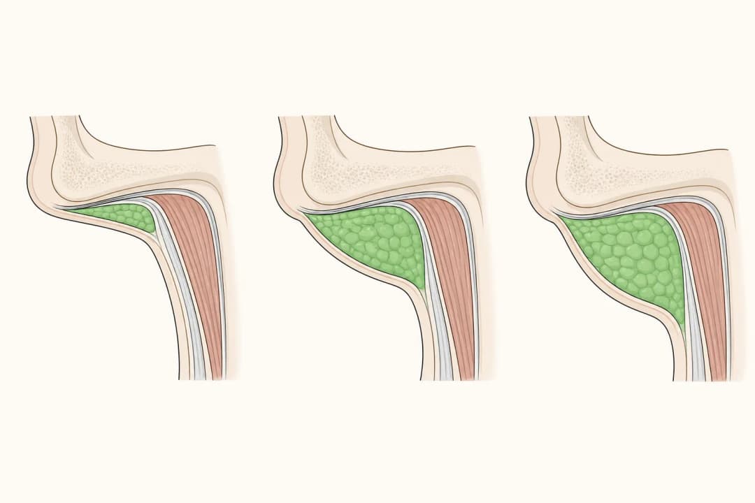 How the structures involved in Submental Fullness differ from normal