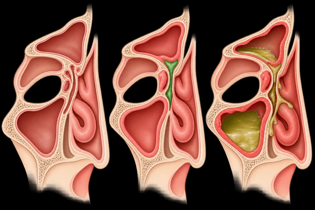 How the structures involved in Chronic Sinusitis differ from normal