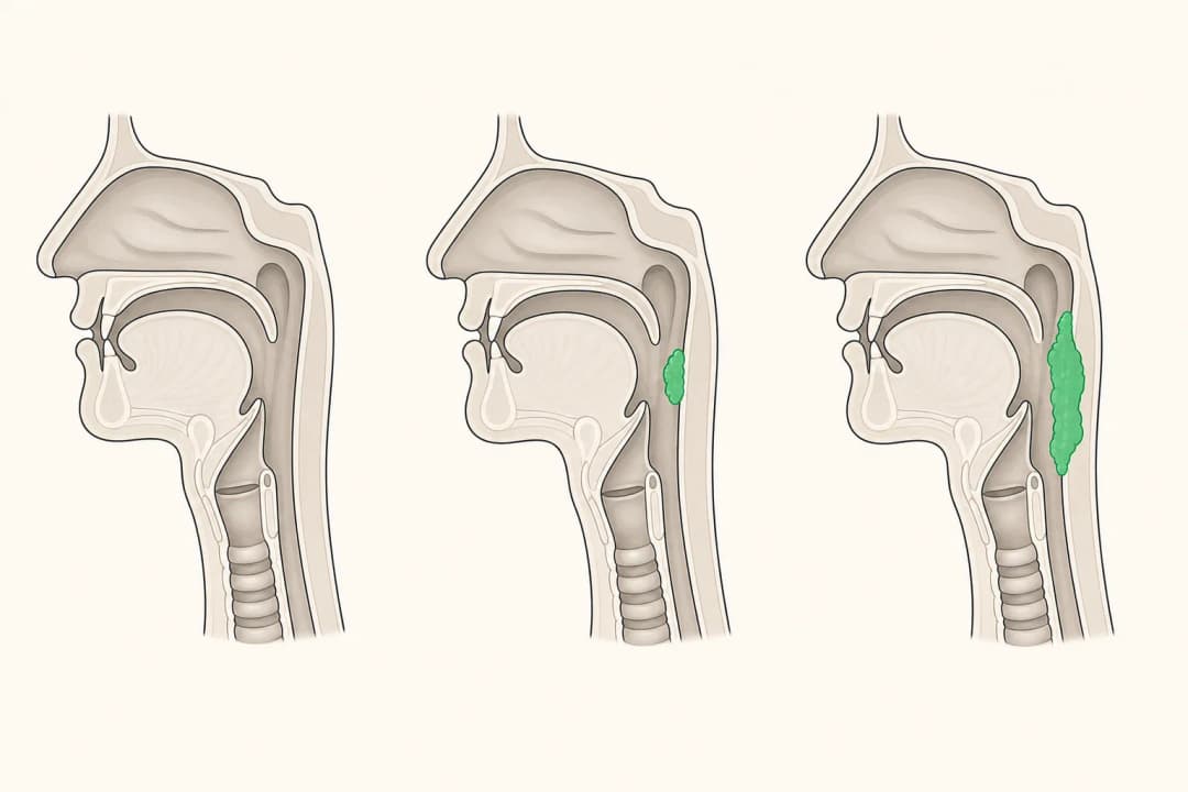 How the structures involved in Throat Cancer differ from normal