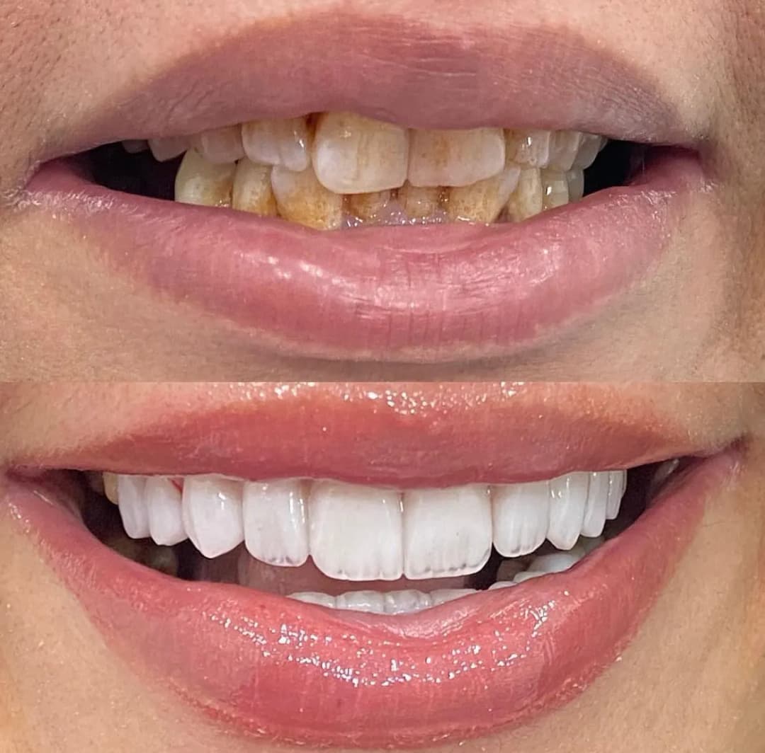 Veneers Dental Center
