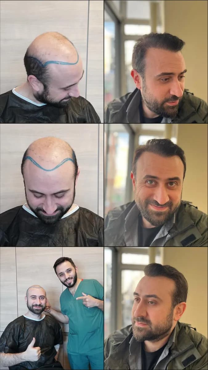 DHI Clinic Turkey -DHI Hair Transplant -Detail Hair Transplant