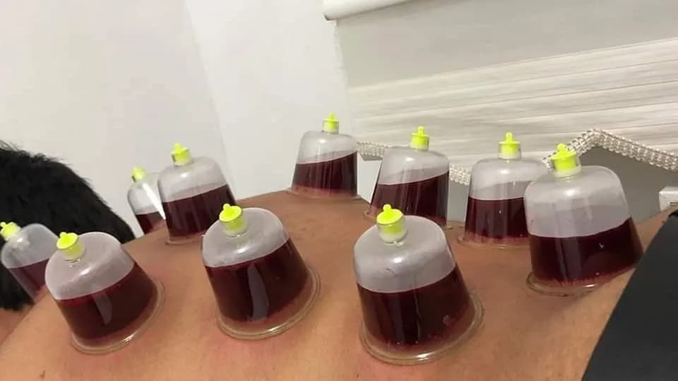 Guzelhacamat_Cuppingtherapy — Dermatology & Skin Care in Istanbul