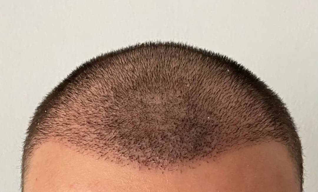 One Hair Clinic Transplantation - Plastic Esthetic