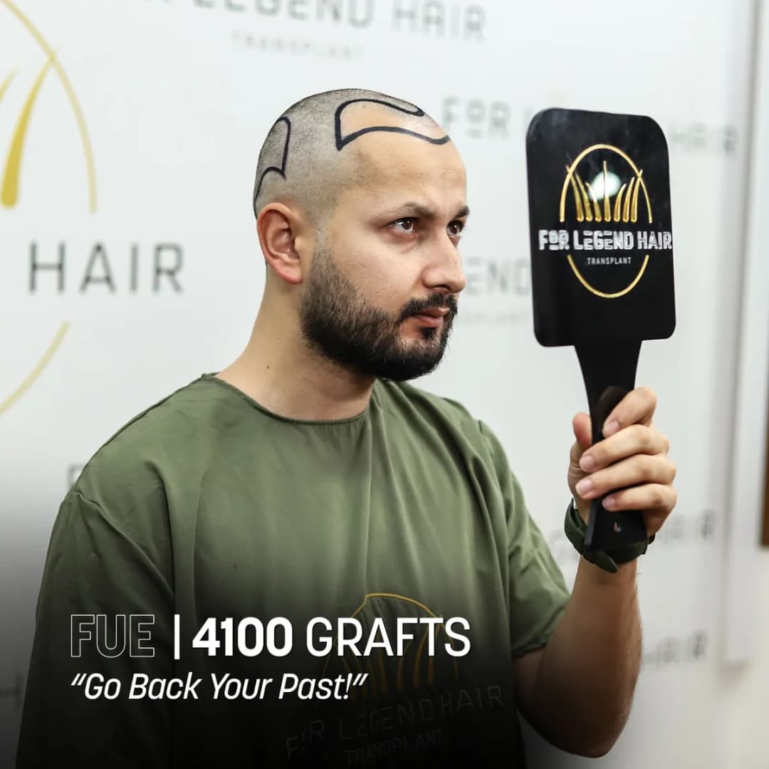 For Legend Hair Transplant